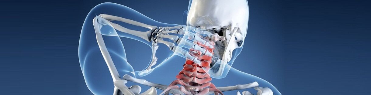Osteochondrose der menschlichen Halswirbelsäule. 