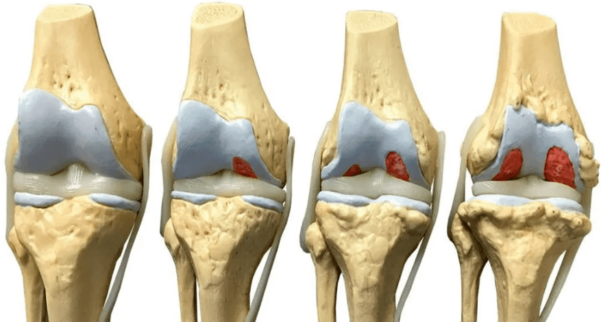Schädigung des Kniegelenks in verschiedenen Stadien der Entstehung von Arthrose. 