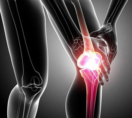 Schädigung des Kniegelenks mit Arthritis und Arthrose