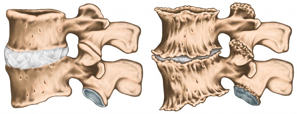 Rückenschmerzen durch Wirbelsäulenverletzung