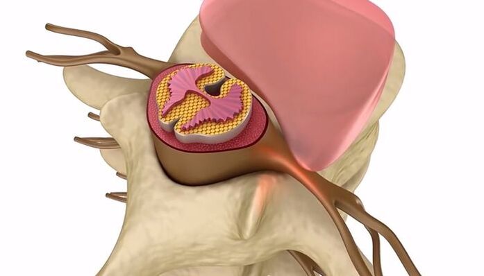 Rückenmarksverletzung bei thorakaler Osteochondrose