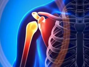 Geschwollenes Schultergelenk aufgrund von Arthrose, einer chronischen Erkrankung des Bewegungsapparates
