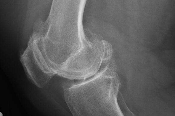 Methoden zur Diagnose der Knie -Arthrose