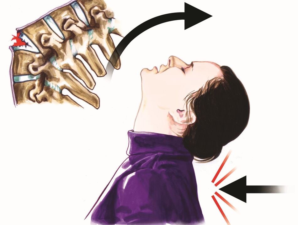 Wirbelsäulenschäden als Ursache für Nackenschmerzen.