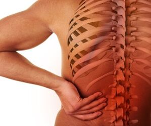 Rückenschmerzen mit lumbaler Osteochondrose