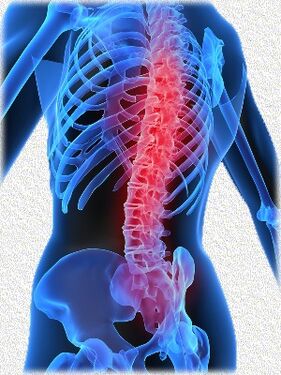 Osteochondrose und Methoden ihrer Behandlung.